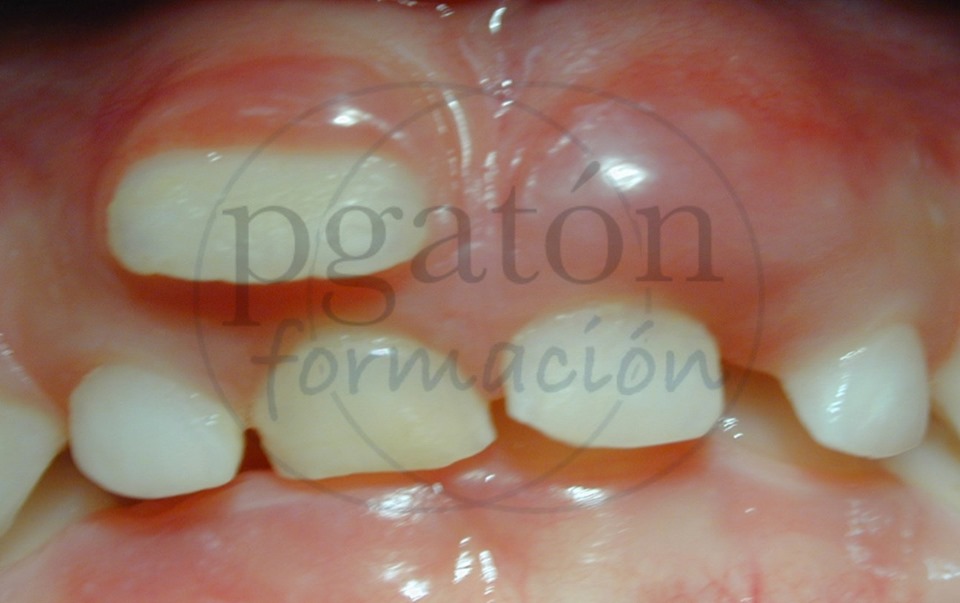 Extracción de dientes temporales