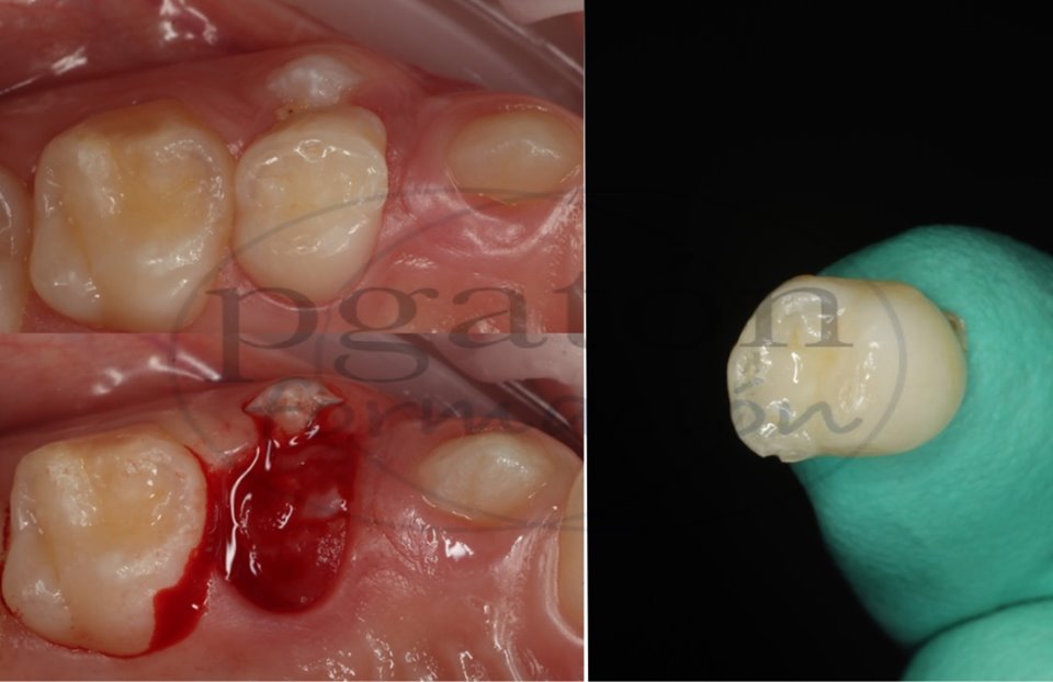 2 Primer molar temporal sin raices retenido