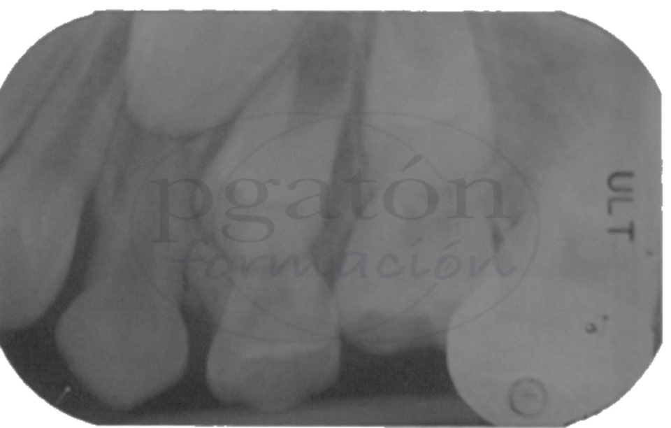 3 radiografia de segundo molar superior retenido