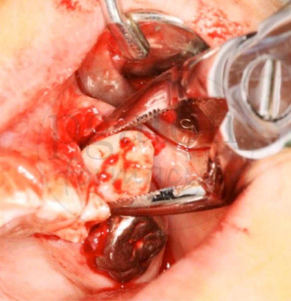 4 erupcion quirurgica segundo molar retenido