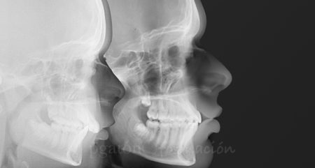 Curso Ortodoncia Interceptiva y Ortopedia funcional en Barcelona