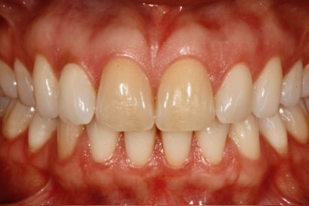 Curso blanqueamiento dental ON-LINE - Imagen 2