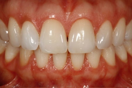 Curso blanqueamiento dental ON-LINE - Imagen 3