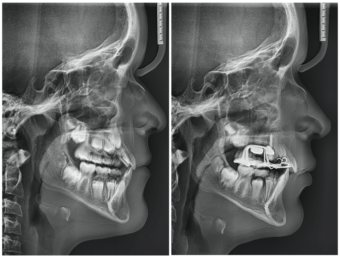 avanzado-ortodoncia-interceptiva-rx