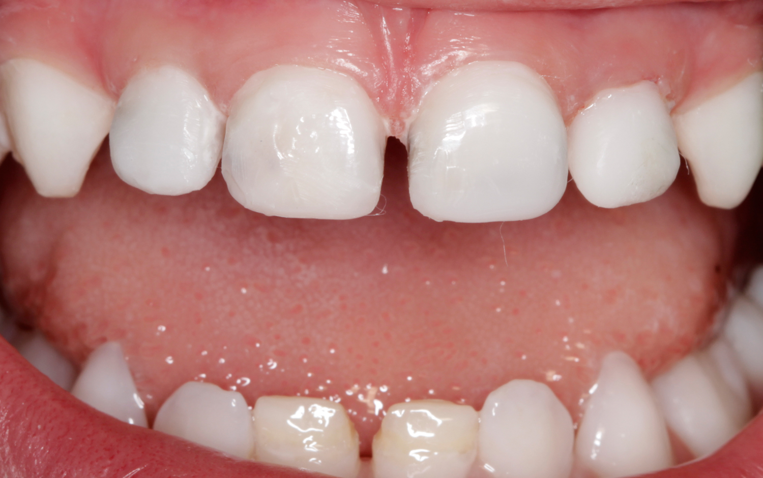 Caso clínico Restauración estética en odontopediatría