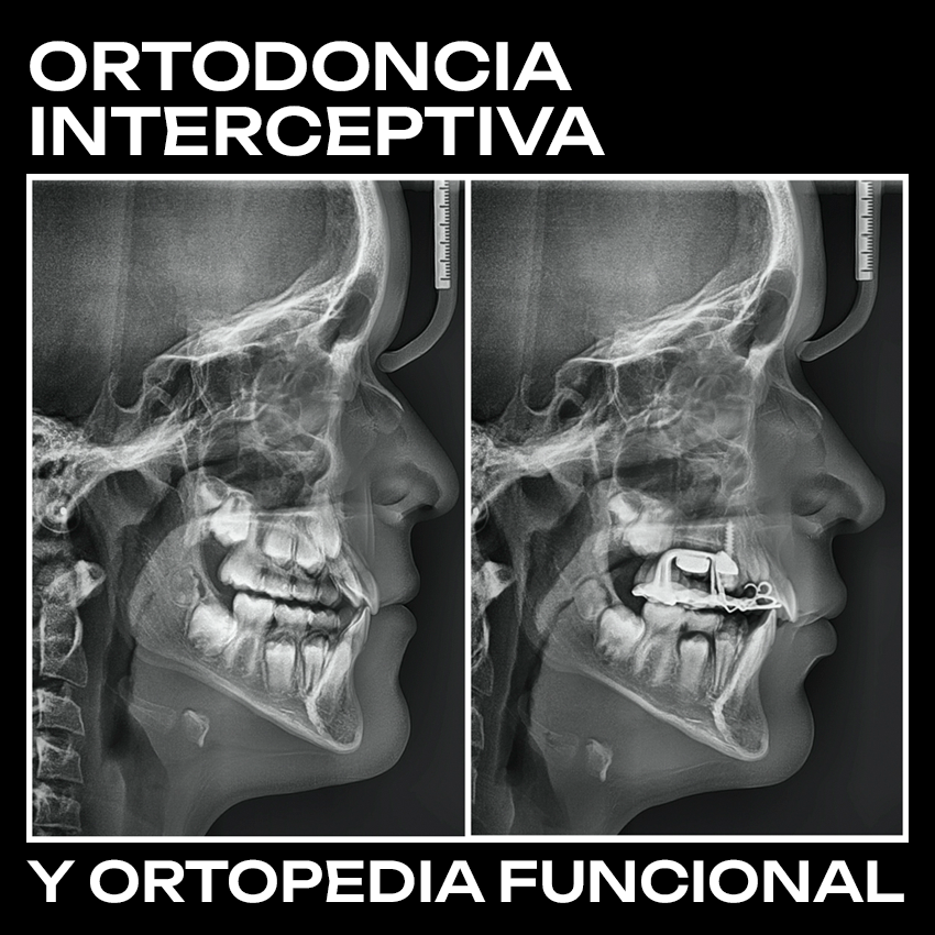 Curso Ortodoncia Interceptiva