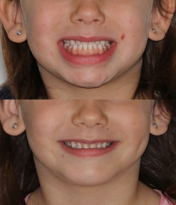 ortodoncia-pcte-pistas-4a-vert